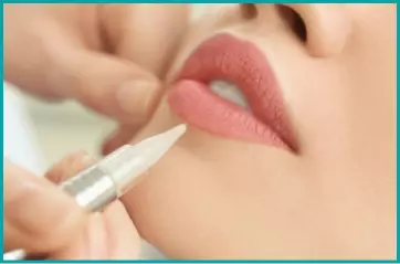 La technique du candylips permet de redessiner le contour des lèvres et les re-pigmenter